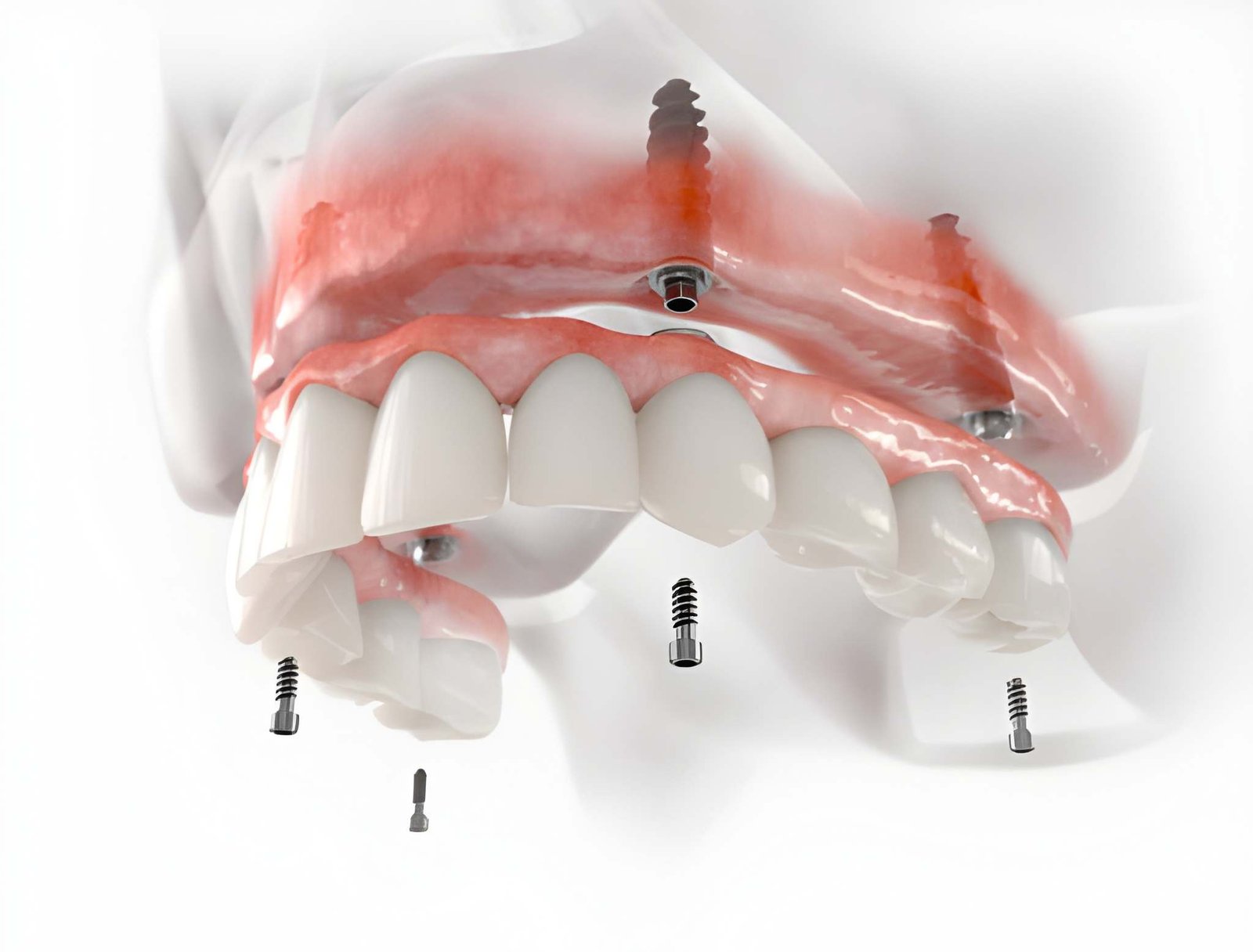 All On 4 implant herkese yapılır mı blog görseli