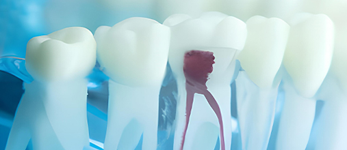 Personalized approach to root canal treatment
