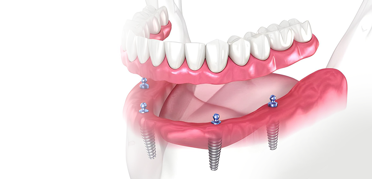 All On 4 implant uygulaması