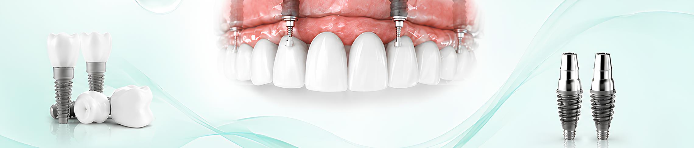 All On 4 implant planlaması