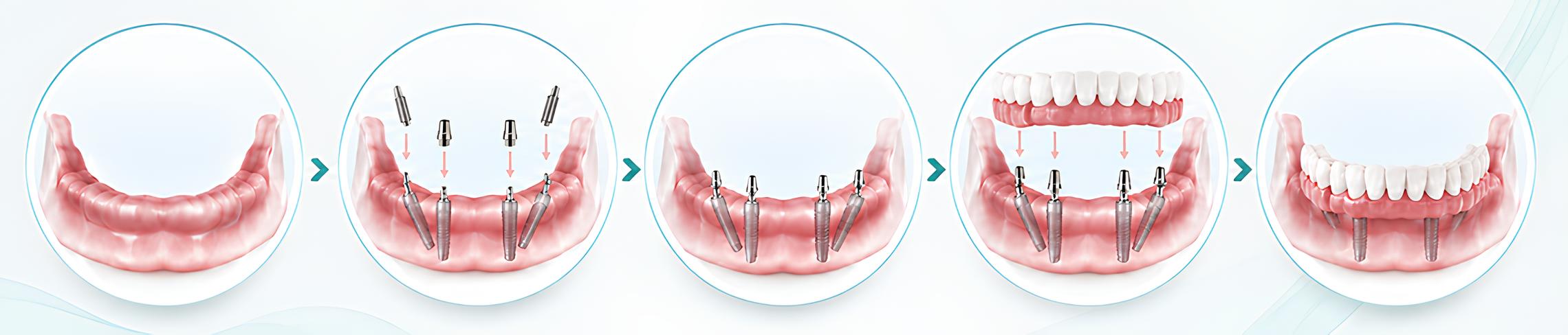 All On 4 implant sonrası sabit protez kontrolü