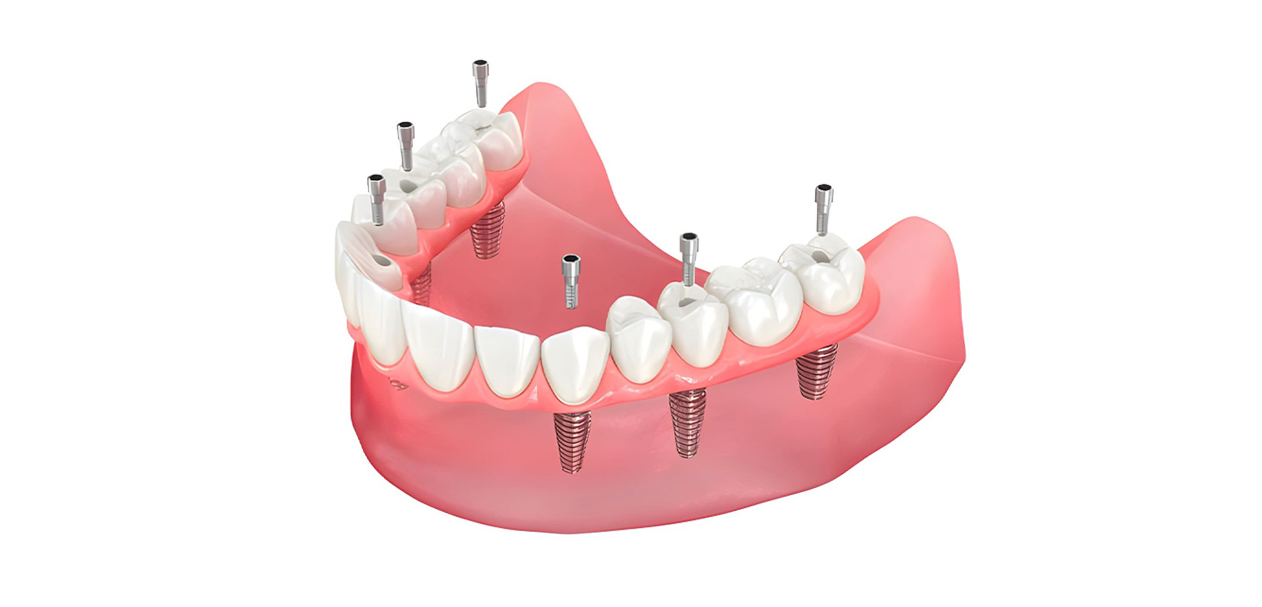 All On 6 implant uygulaması