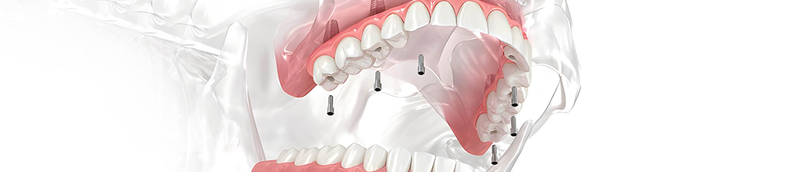 All On 6 implant planlaması