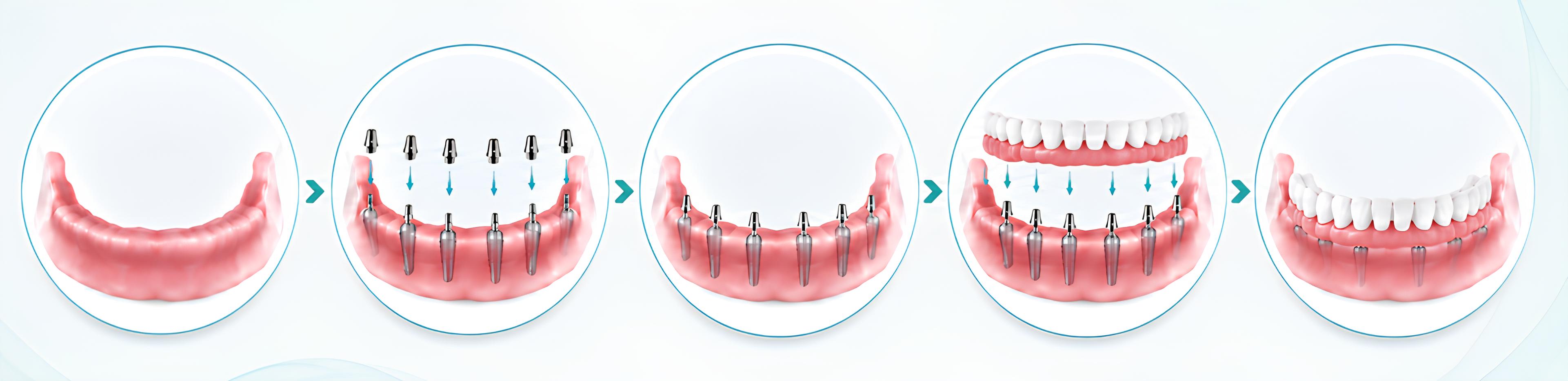 All On 6 implant sonrası sabit protez kontrolü