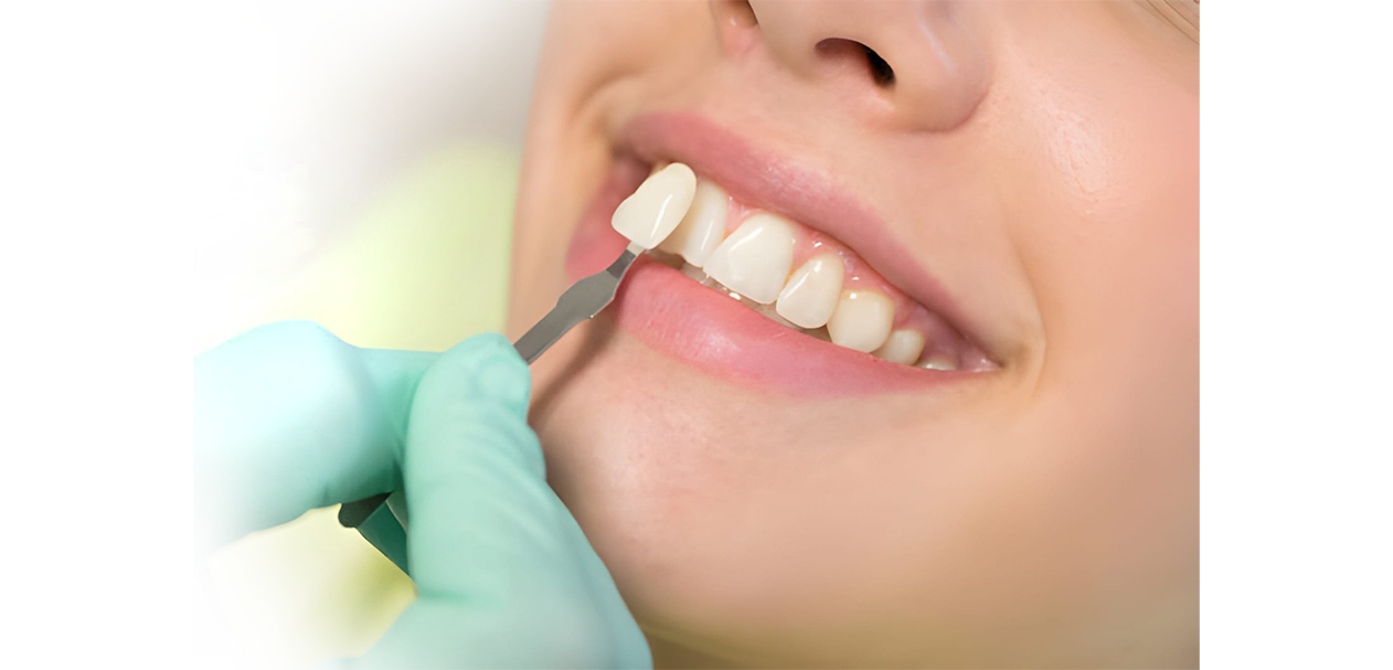 Lamine veneer uygulaması