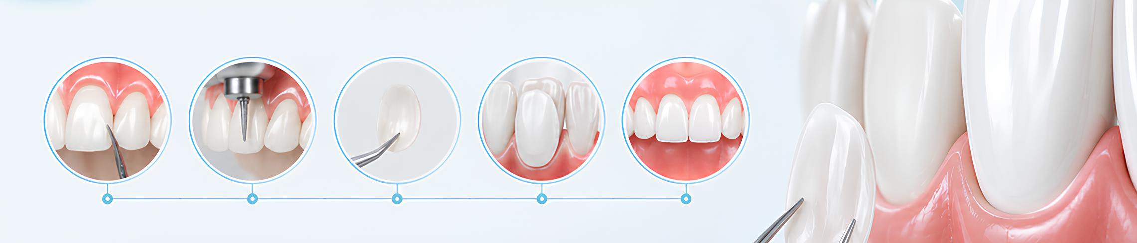 Lamine veneer sonrası sonuç kontrolü